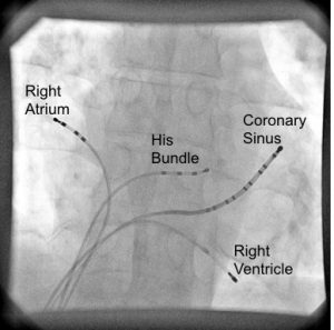 Electrophysiology Study Heart Rhythm Clinic